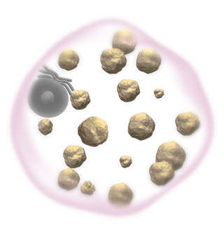 Gaucher Cell